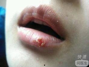 吃瓜嘴角发红,嘴角红润的秘密