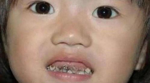 吃瓜下牙包上牙,揭秘下牙包上牙的趣味现象